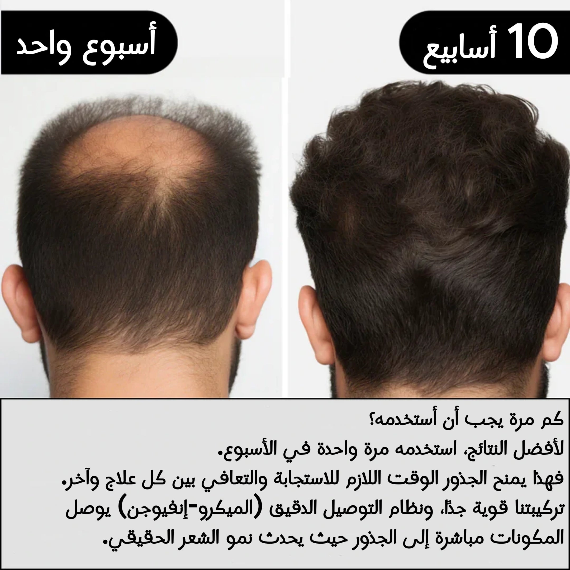 ألفا إنفيوز™ - نظام إعادة إنبات الشعر الطبيعي